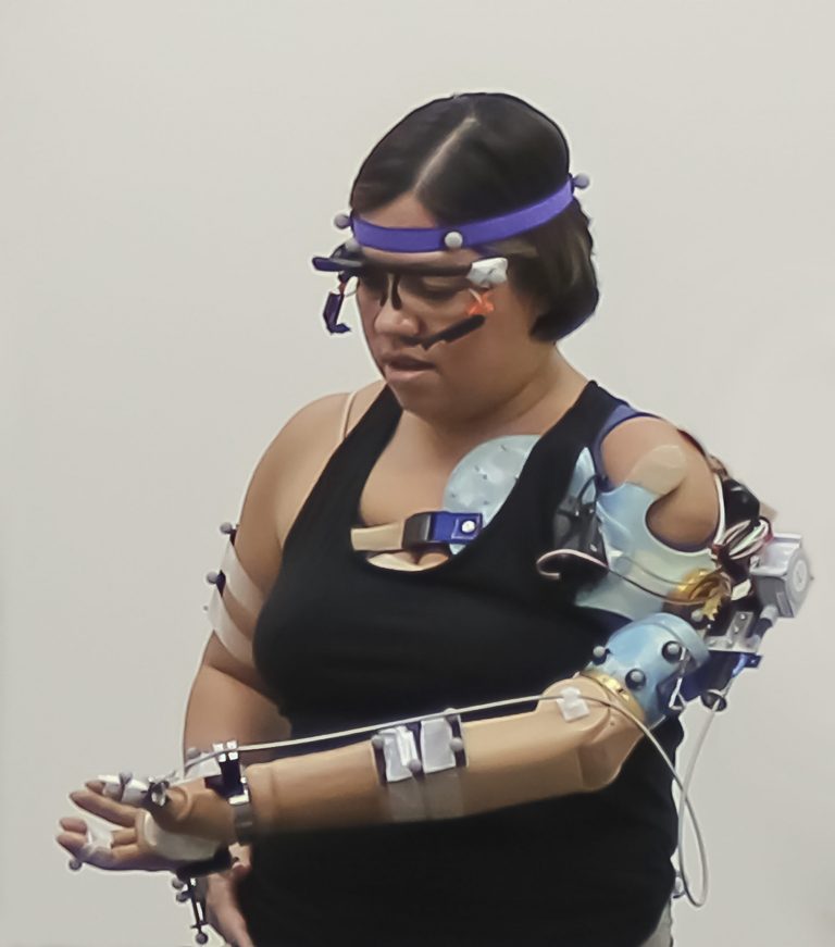 Brazo biónico recupera el control natural de los pacientes con amputaciones de miembros superiores