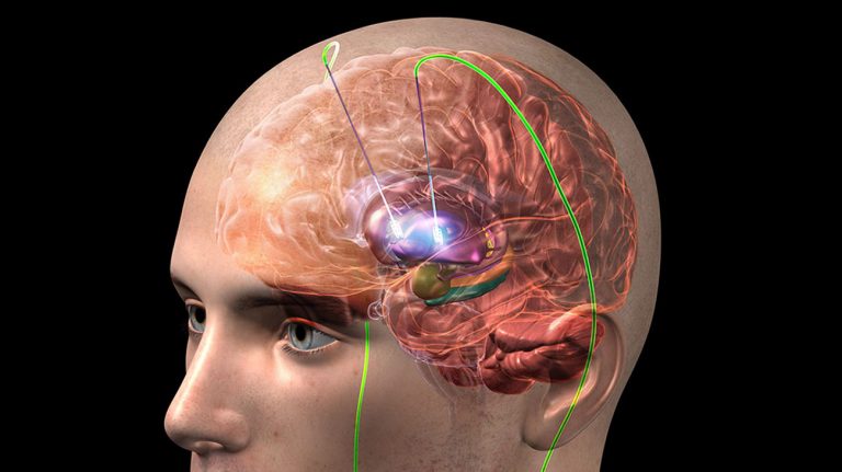 Cirugía de estimulación cerebral profunda, alivio para los temblores de Parkison